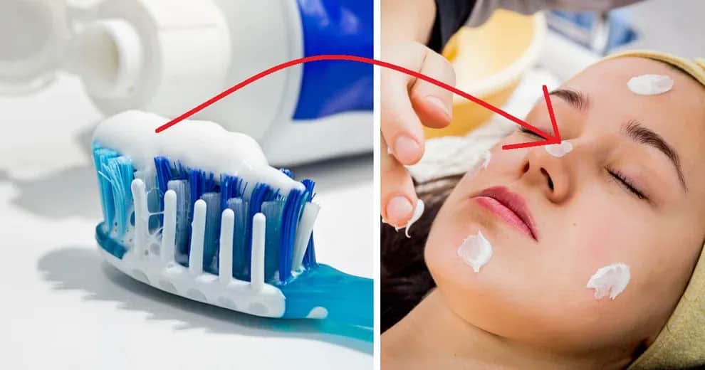 Jak długo trzymać pastę do zębów na pryszcze, aby uniknąć podrażnień?