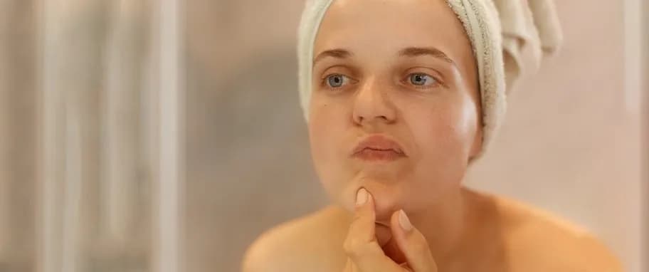 Jak pozbyć się pryszcza w 5 minut: szybkie metody na ulgę