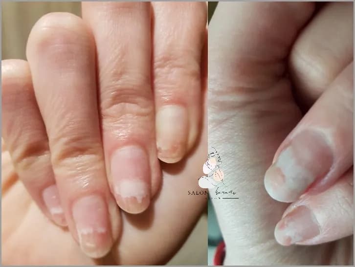 Jak skutecznie leczyć grzybicę paznokci u rąk po hybrydzie?