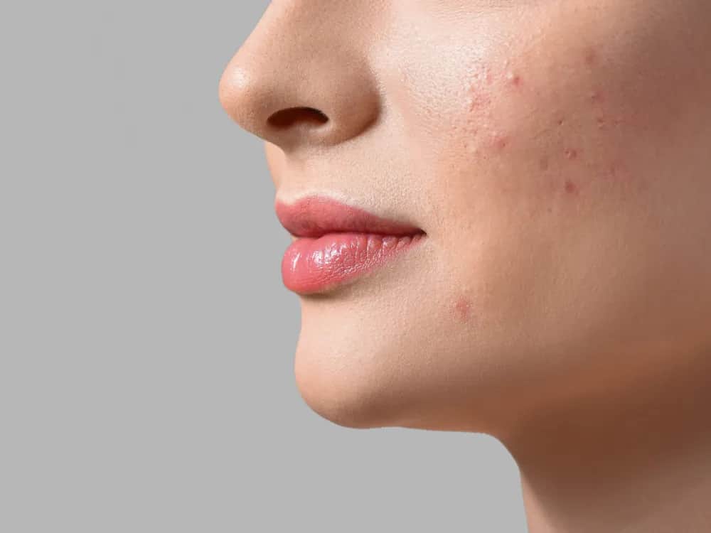 Czy pryszcze się wyciska? Poznaj ryzyko i lepsze metody pielęgnacji