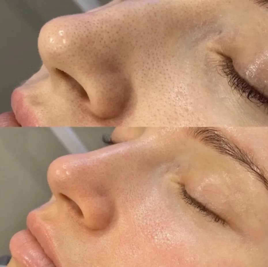 Mikrodermabrazja czy warto? Odkryj jej prawdziwe efekty i ryzyko