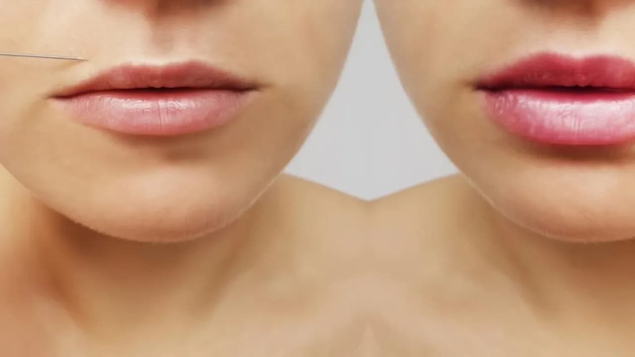 Po jakim czasie widać efekty botoksu? Zaskakujące informacje o czasie działania