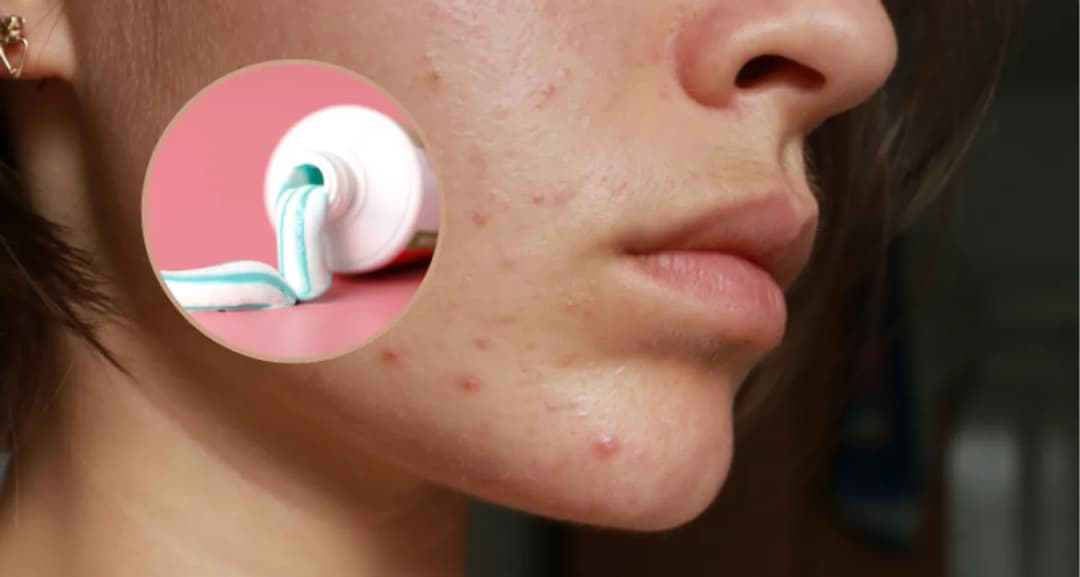 Jak usunąć pryszcze z twarzy - skuteczne metody na szybkie rezultaty