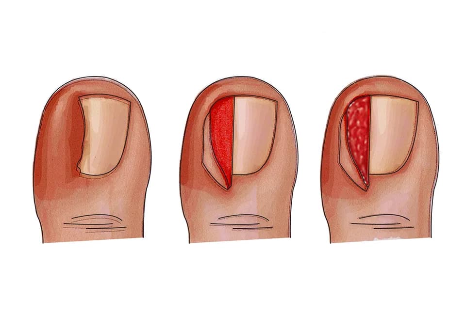 Jak pozbyć się wrastającego paznokcia - skuteczne metody i porady
