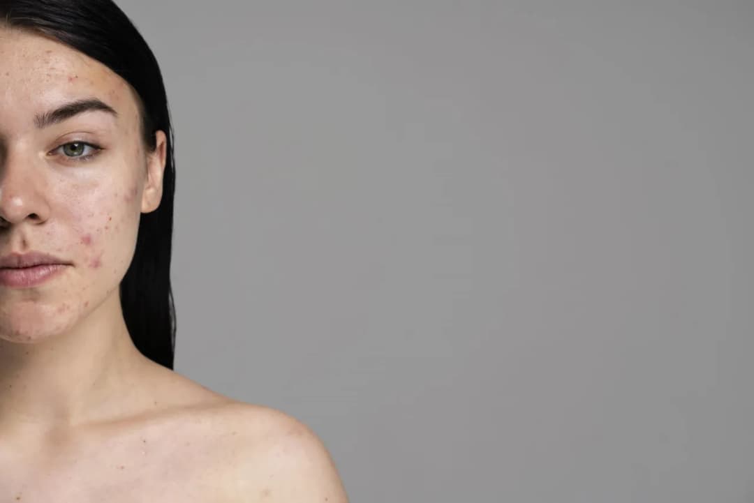 Jak pozbyć się blizn po pryszczach domowe sposoby, które działają