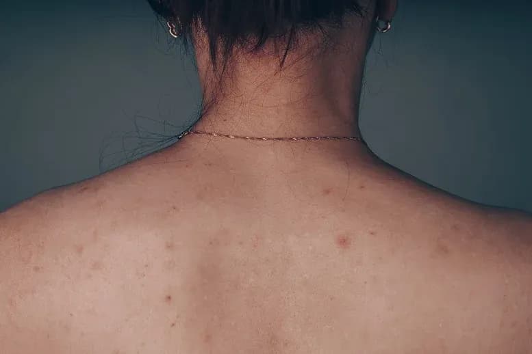 Jak skutecznie pozbyć się pryszczy na plecach i odzyskać pewność siebie