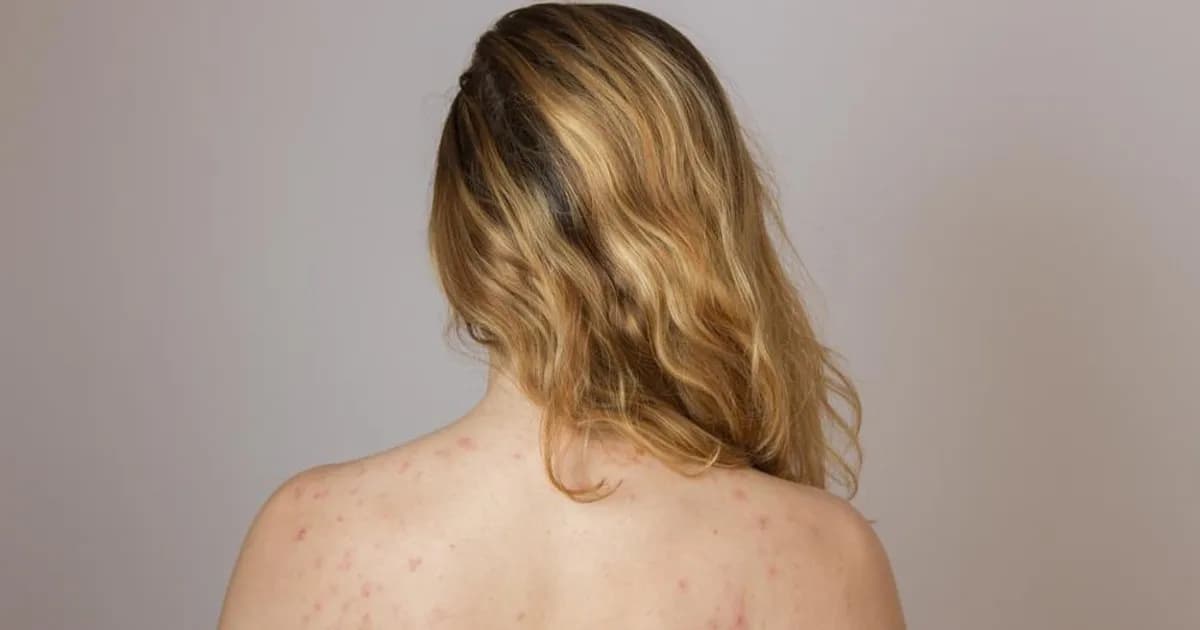 Dlaczego mam pryszcze na plecach? Odkryj przyczyny i skuteczne metody leczenia