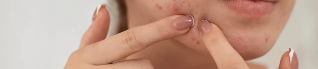 Kiedy wyciskać pryszcze, aby uniknąć blizn i infekcji?