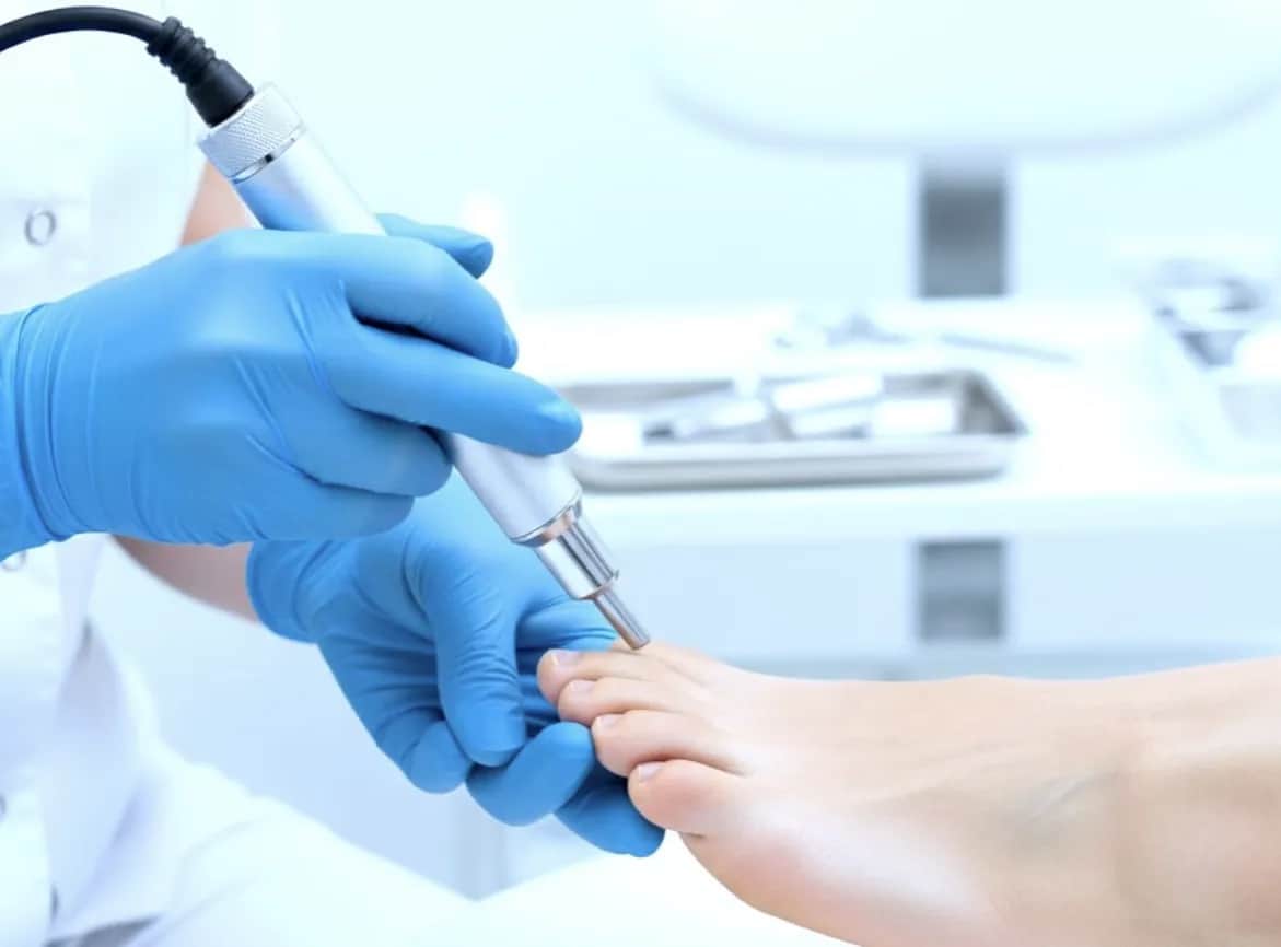 Szybkie i bezpieczne metody usuwania kurzajek – co naprawdę działa?