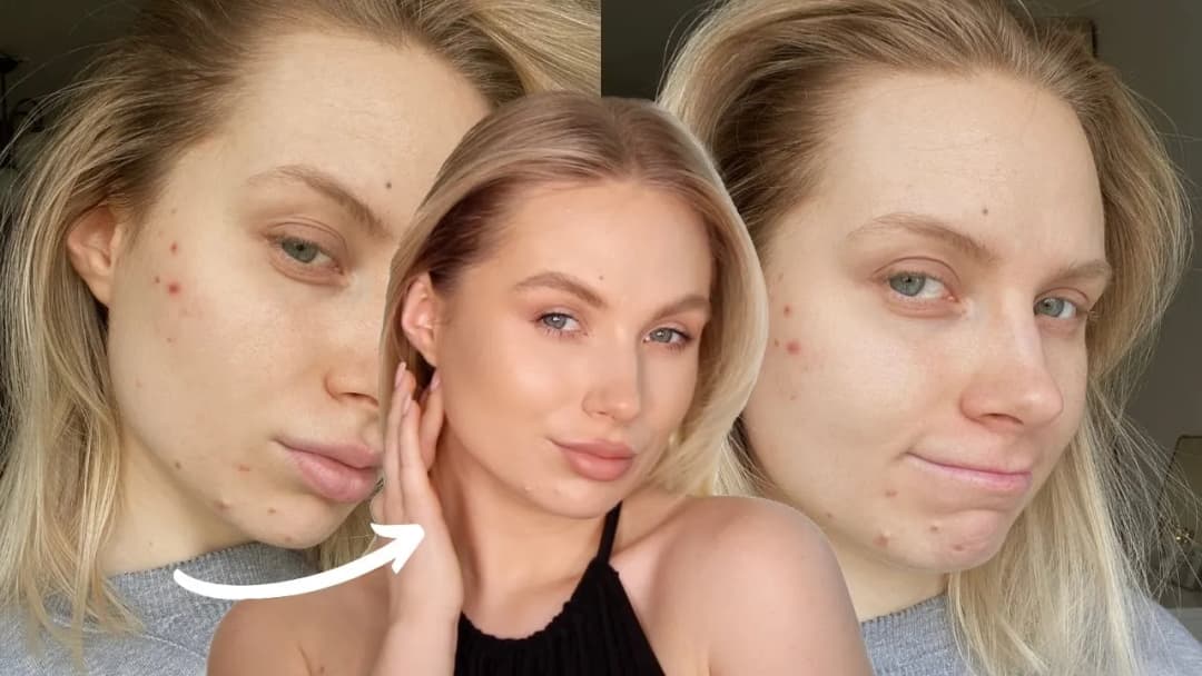 Jak dobrze zakryć pryszcza i uniknąć widocznych niedoskonałości