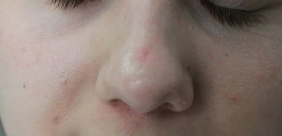 Jak szybko pozbyć się strupa po pryszczu i uniknąć blizn