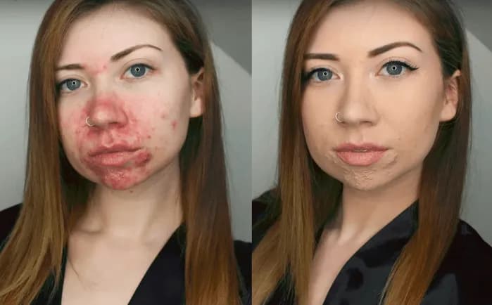 Jak ukryć pryszcze makijażem - skuteczne sposoby na naturalny efekt