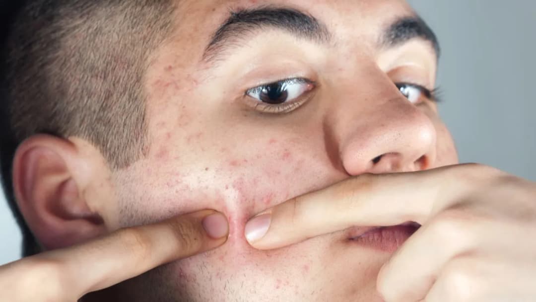 Jak szybko pozbyć się pryszcza pod skórą - skuteczne metody na trądzik