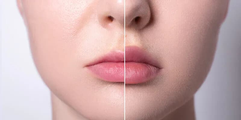 Czy powiększanie ust kwasem hialuronowym jest bezpieczne? Poznaj ryzyko