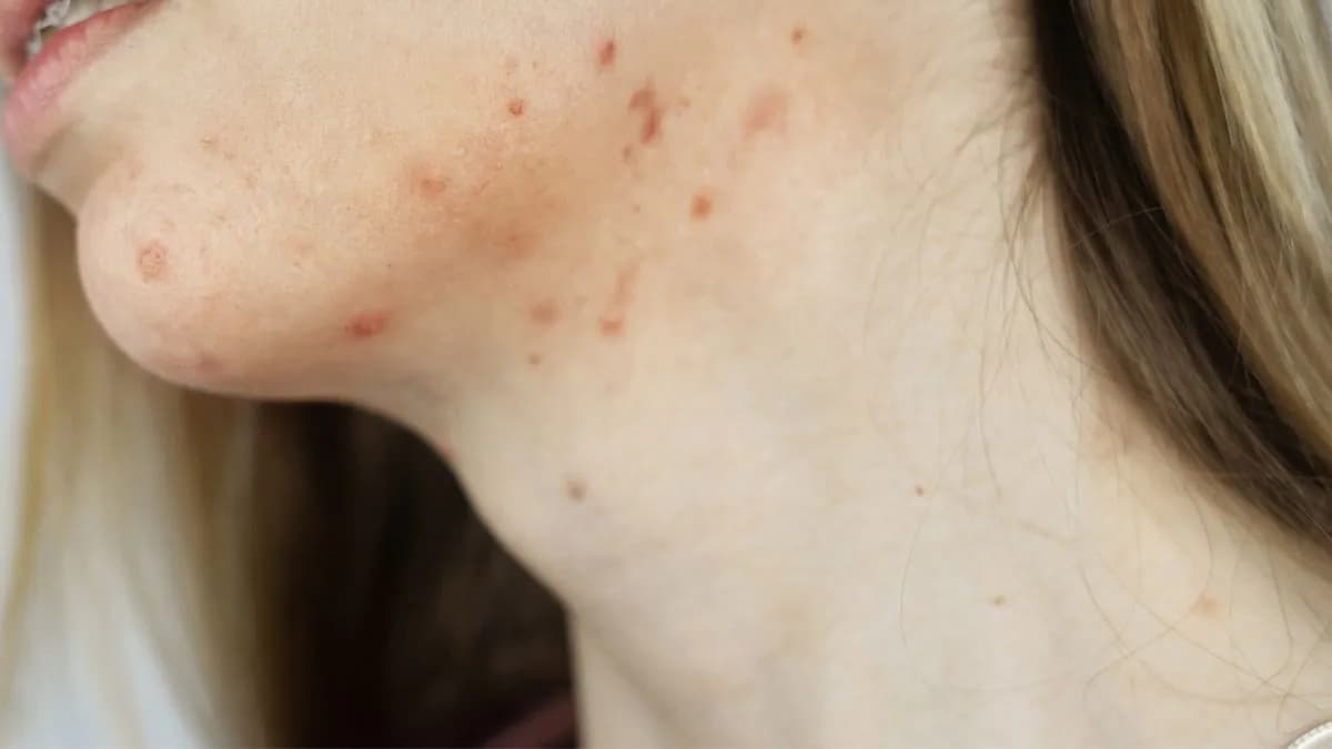Pryszcz którego nie da się wycisnąć: przyczyny, objawy i skuteczne leczenie