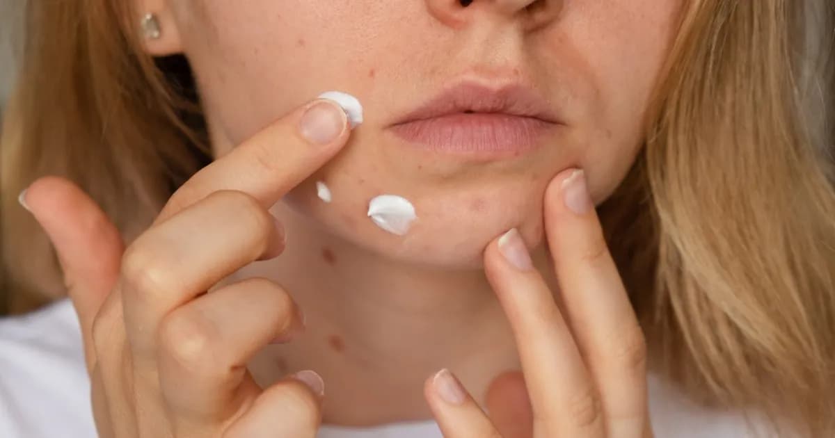 Co jest dobre na pryszcze? Skuteczne metody na walkę z trądzikiem