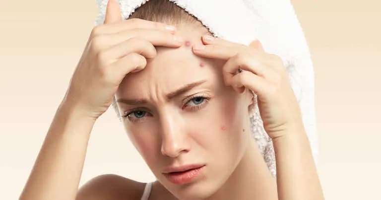 Jak szybko pozbyć się pryszcza i uniknąć blizn na skórze