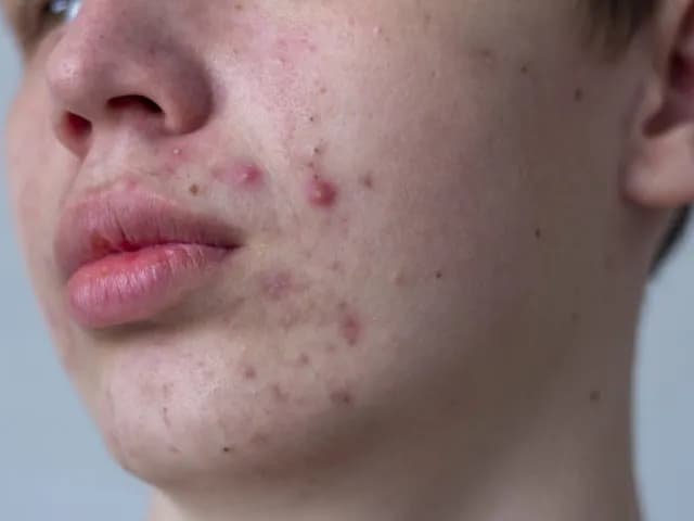 Od czego są pryszcze na brodzie? Odkryj nieznane przyczyny i rozwiązania