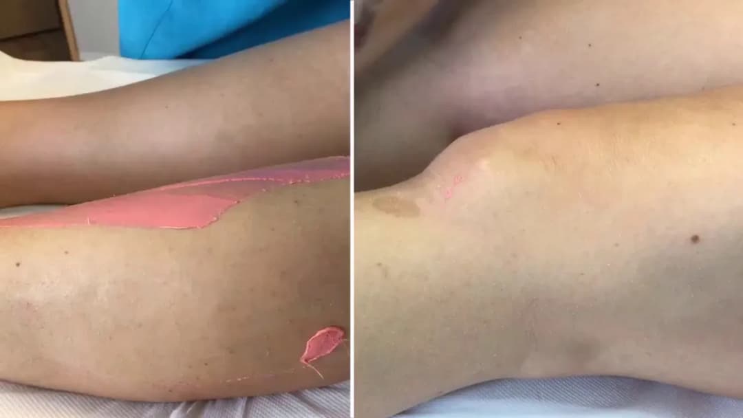 Depilacja woskiem co ile? Odkryj idealne odstępy dla skóry