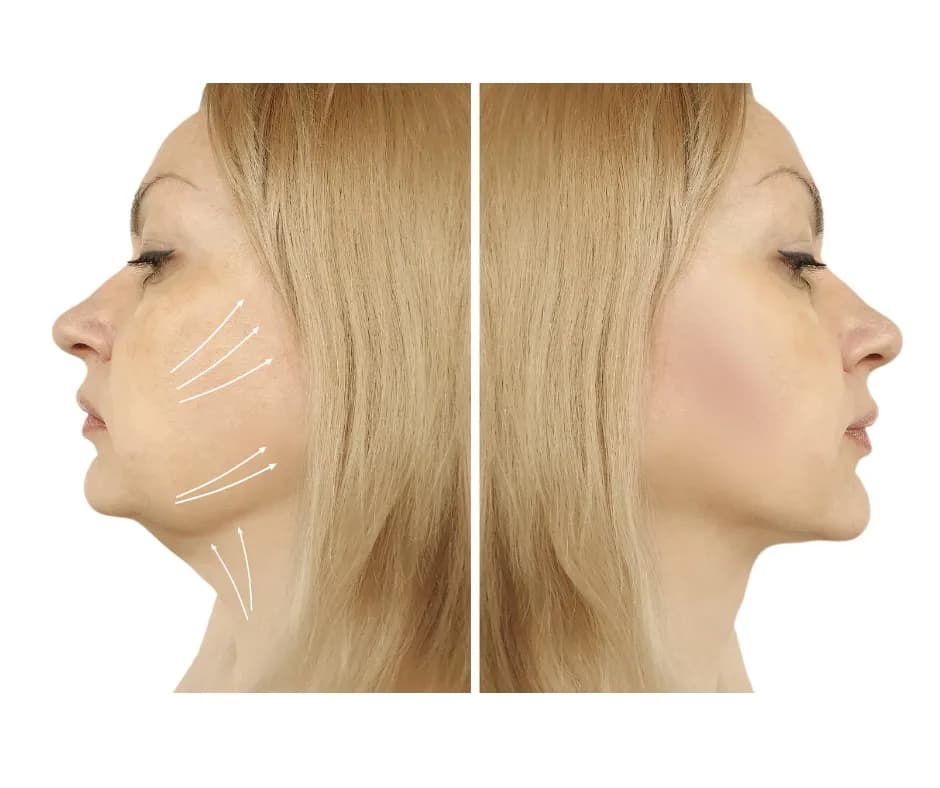 Ile kosztuje liposukcja podbródka? Ceny i ukryte wydatki, które musisz znać