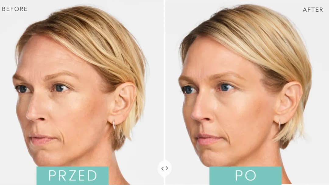 Radiesse czy kwas hialuronowy - który wypełniacz jest lepszy dla Ciebie?