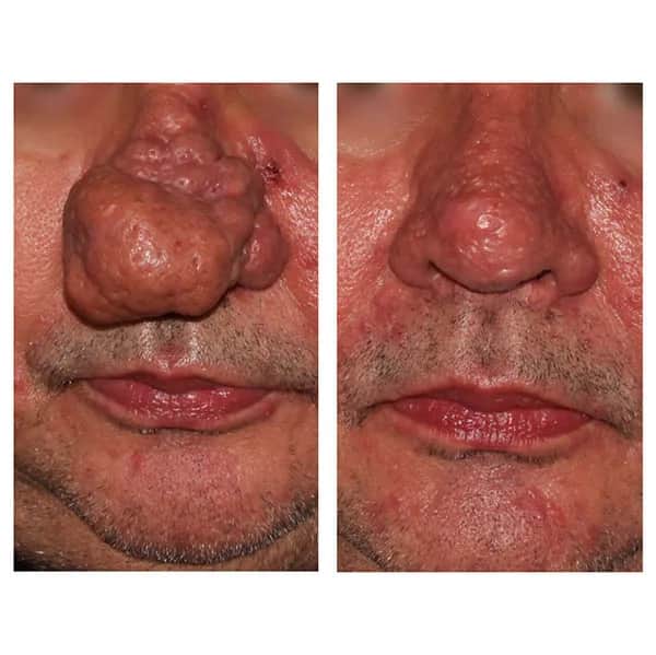 Skuteczne sposoby na pozbycie się pryszcza w nosie bez bólu