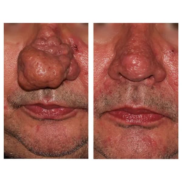 Skuteczne sposoby na pozbycie się pryszcza w nosie bez bólu