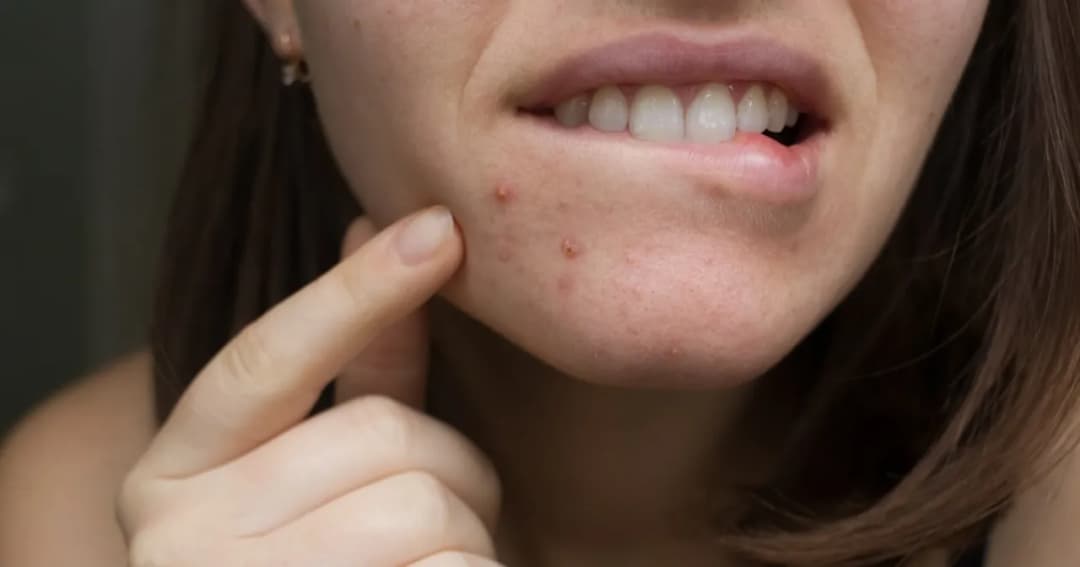 Jak zmniejszyć stan zapalny pryszcza? Skuteczne domowe sposoby