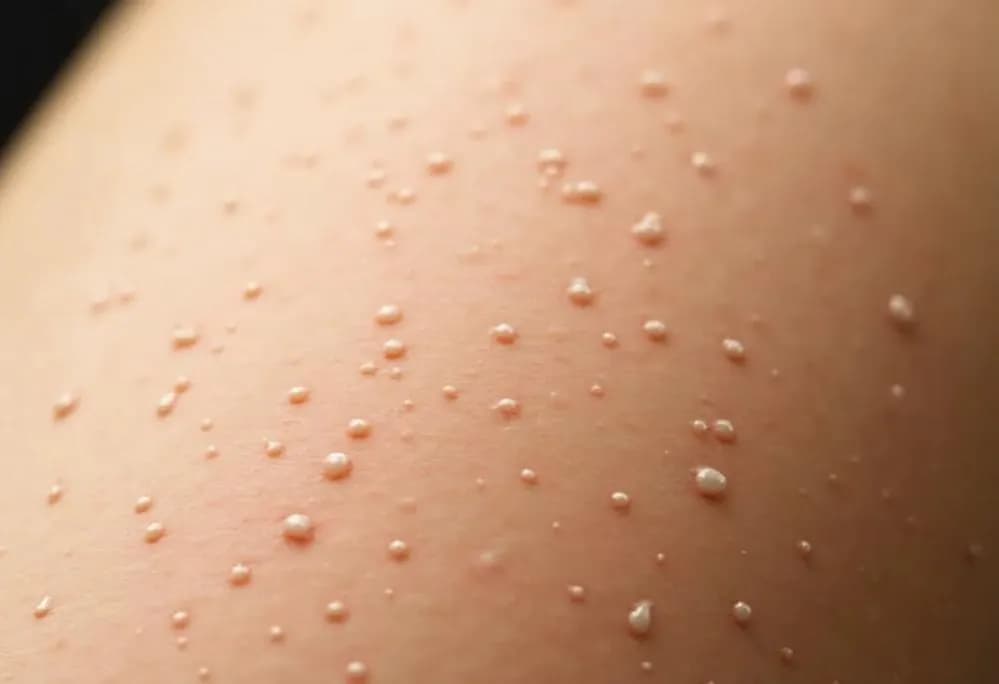 Grudki po kwasie hialuronowym: kiedy znikną i co robić?