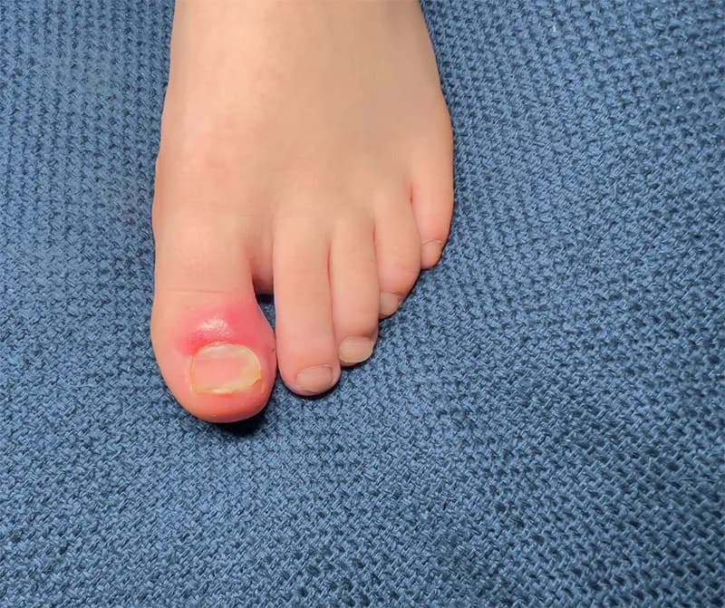 Co na wrastający paznokieć u dziecka? Skuteczne metody leczenia i zapobiegania