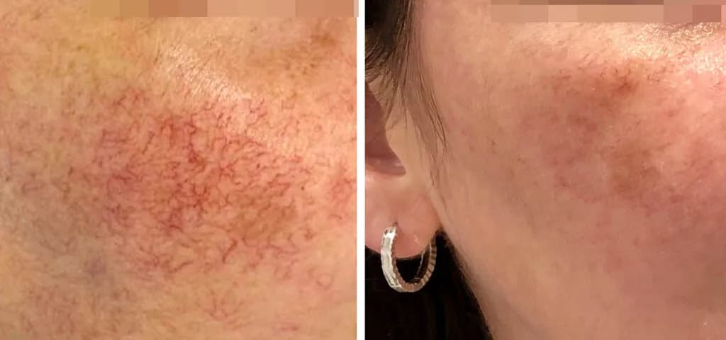 Jak długo goi się skóra po laserze frakcyjnym? Czas regeneracji