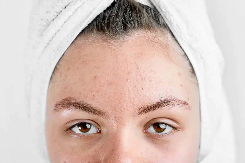 Jak długo trzymać maść ichtiolową na pryszczu, aby uzyskać efekty?