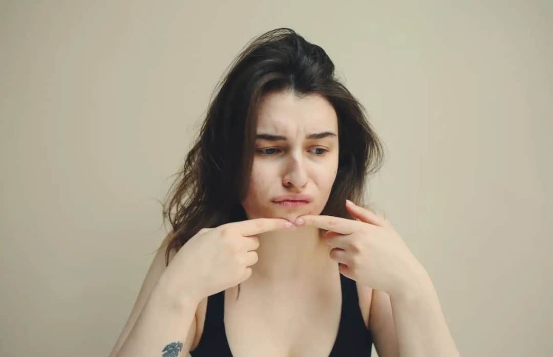 Skuteczne sposoby, co zrobić żeby nie mieć pryszczy i cieszyć się zdrową skórą