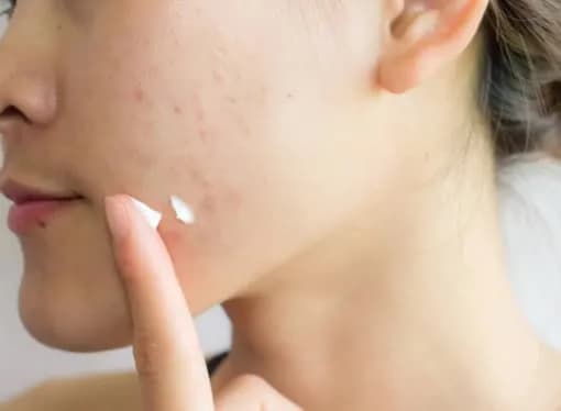 Czy pasta pomaga na pryszcze? Dlaczego lepiej jej unikać i co stosować?