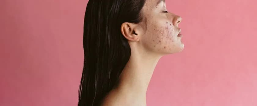 Jak pozbyć się dużego pryszcza szybko i skutecznie bez bólu