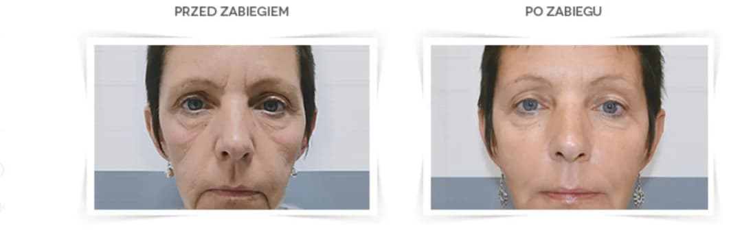 Po jakim czasie widać efekty kwasu hialuronowego? Sprawdź, zanim zdecydujesz