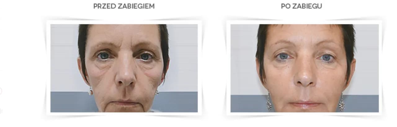 Po jakim czasie widać efekty kwasu hialuronowego? Sprawdź, zanim zdecydujesz