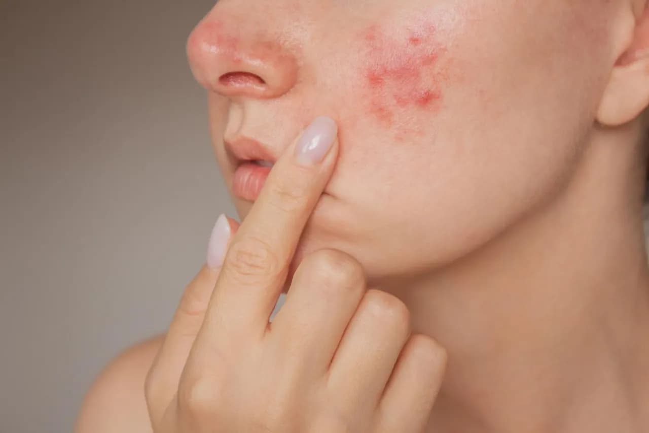 Czy plastry na pryszcze działają? Odkryj ich skuteczność i działanie