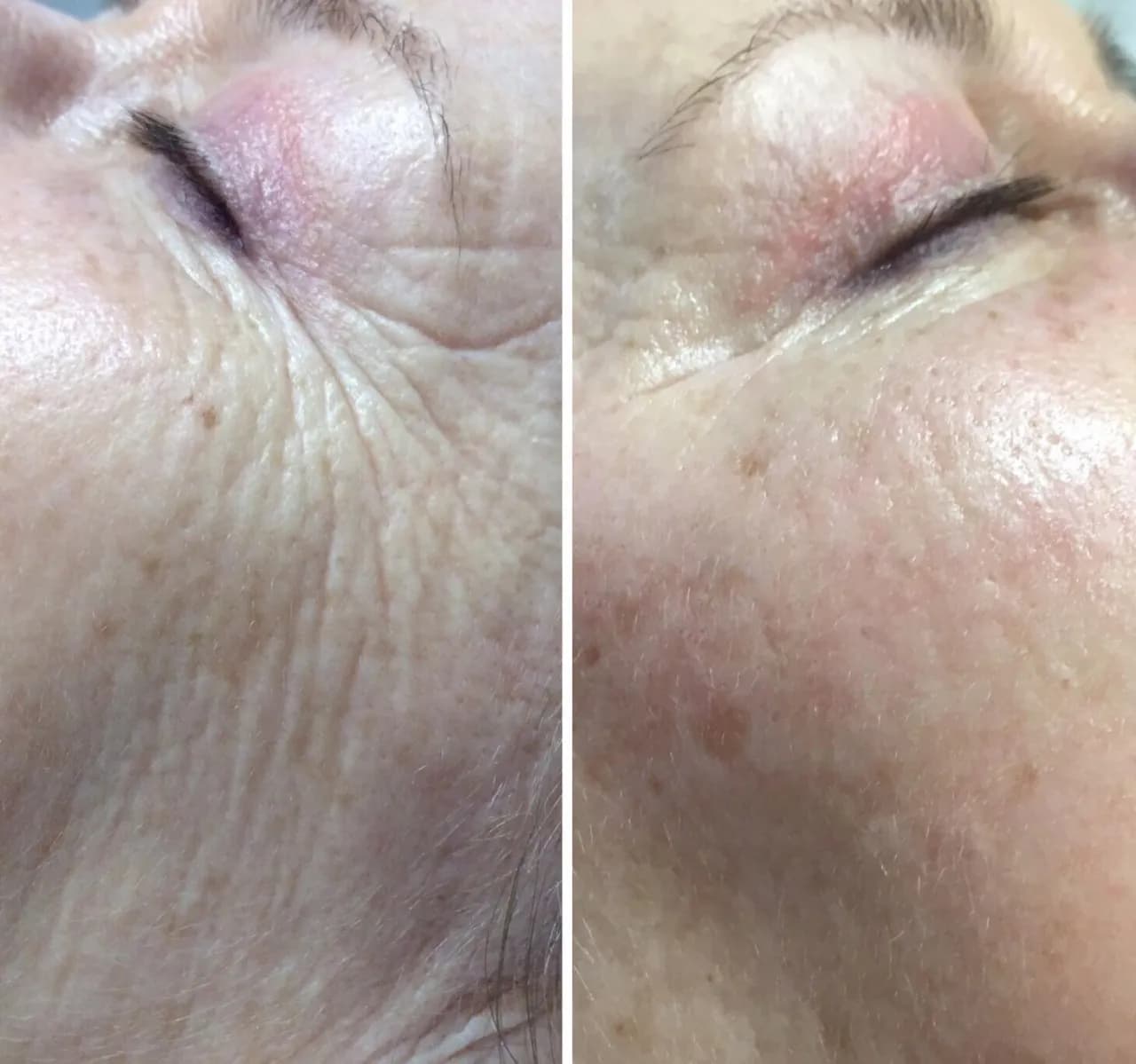 Botoks czy kwas hialuronowy na zmarszczki - co naprawdę działa lepiej?