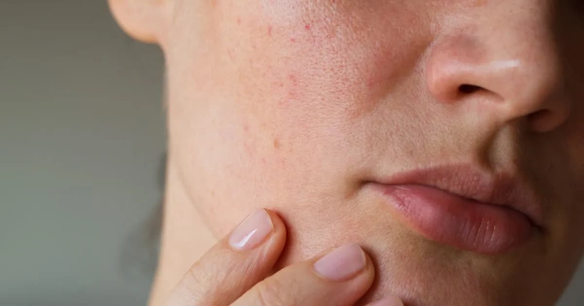 Pryszcze na policzkach od czego? Oto najczęstsze przyczyny i rozwiązania