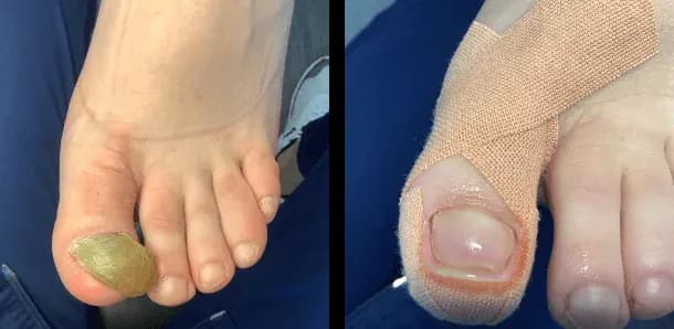 Jak obciąć paznokcie u nóg, aby uniknąć bólu i infekcji