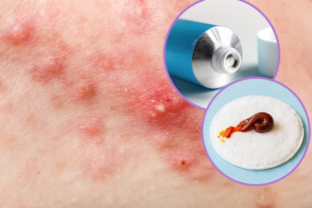 Jak długo trzymać maść ichtiolową na pryszcze, by uniknąć blizn?