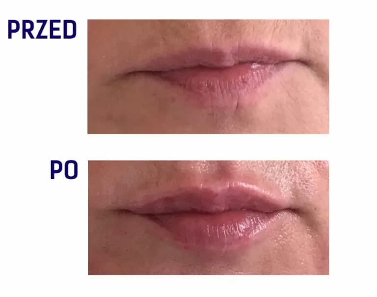 Powiększanie ust czy warto? Zobacz zalety i ryzyka zabiegu