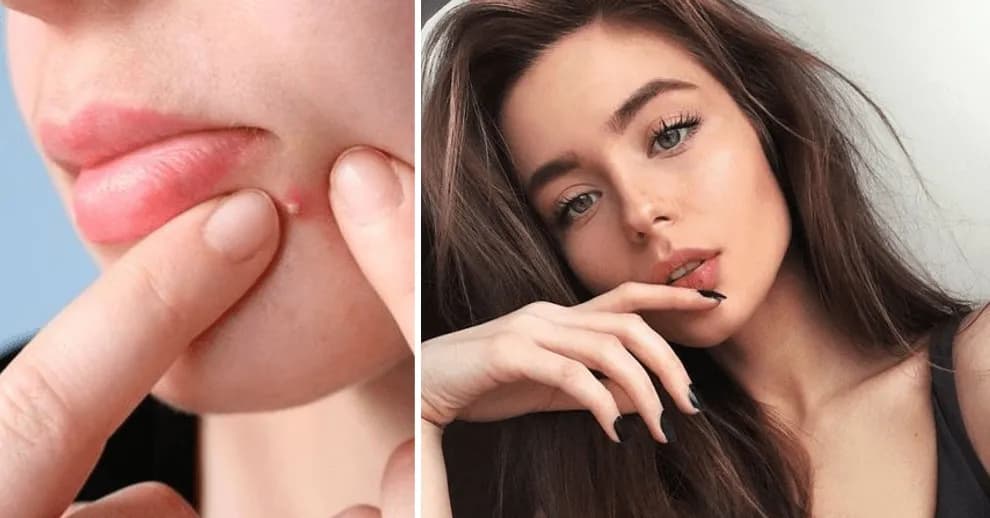 Jak wysuszyć pryszcza szybko i skutecznie - sprawdzone metody