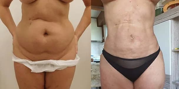 Liposukcja ultradźwiękowa ile zabiegów potrzebujesz, by schudnąć?