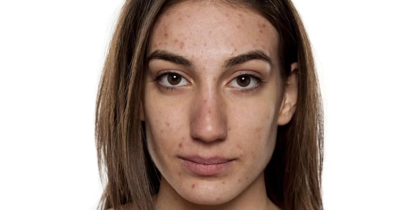 Skuteczne sposoby na czerwone plamy po pryszczach, które zadziałają