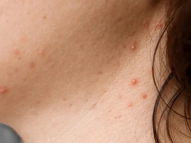 Pryszcze na szyi co oznaczają i jak skutecznie je leczyć