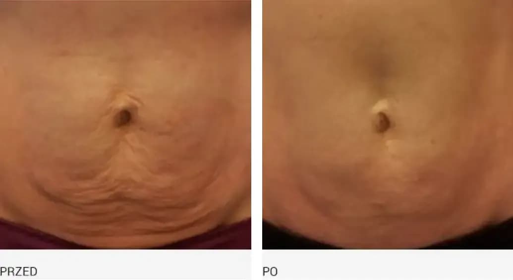 Endermologia jak długo utrzymują się efekty i co na nie wpływa?