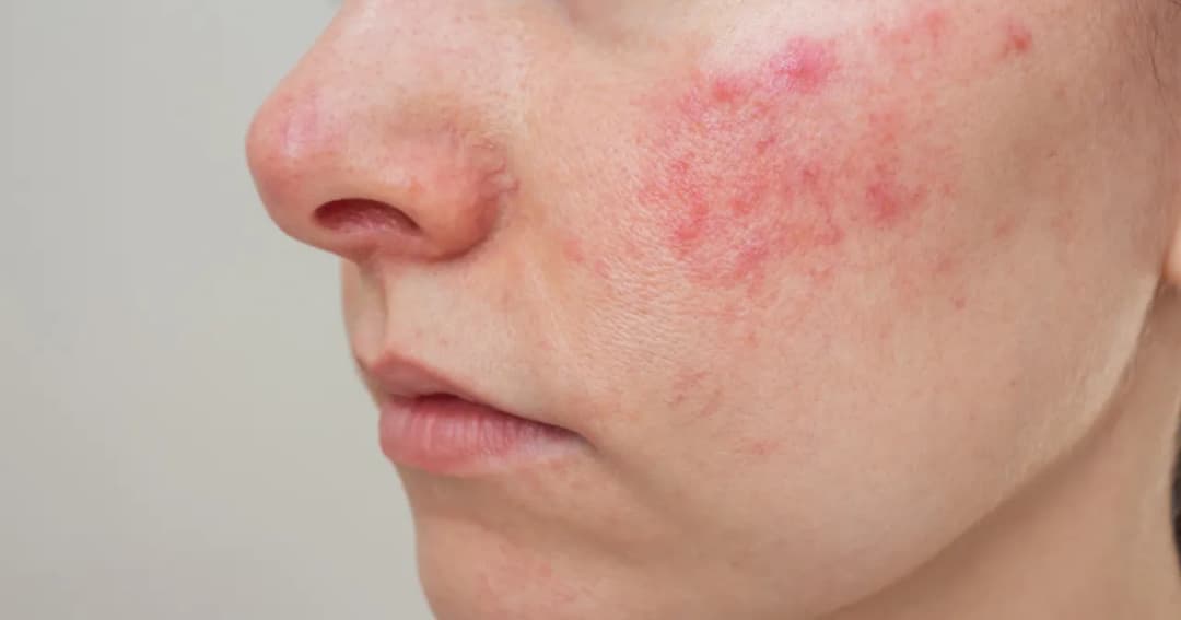 Pryszcze na twarzy znaczenie: co mówią o twoim zdrowiu?
