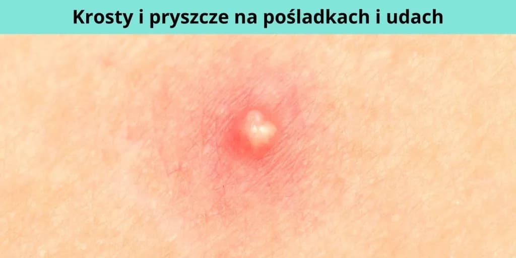 Jak powstaje pryszcz i co naprawdę wpływa na ich pojawianie się